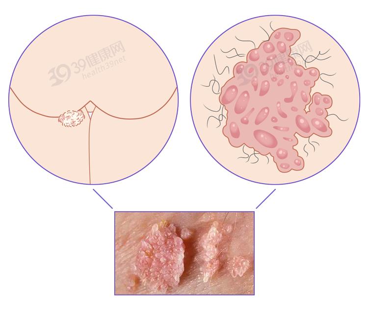 十几岁感染HPV，青少年如何应对与预防_最佳精选