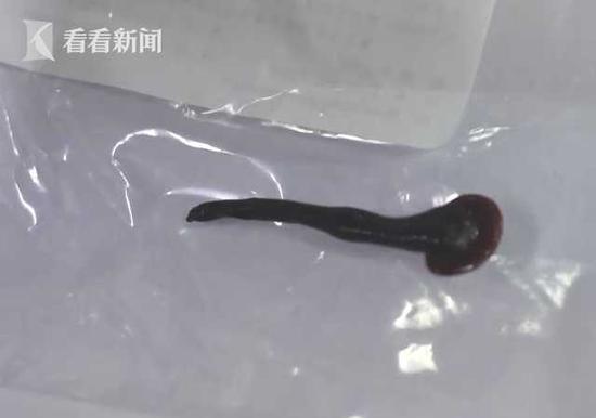 震惊！7岁孩子做雾化竟咳出活体蚂蝗，引发社会关注