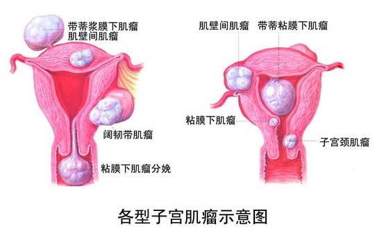 震惊！39岁女子竟长出36枚子宫肌瘤，医生揭示背后真相！