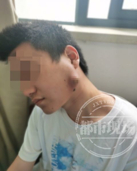 男子脸肿四天后意外吸住磁铁，揭秘罕见现象背后的真相！